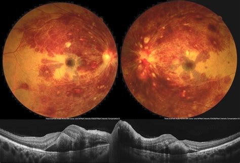 Leukemic Retinopathy - Retina Image Bank
