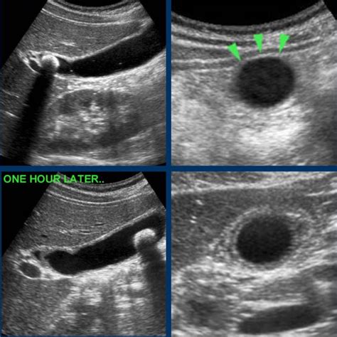 Gallbladder Ultrasound Stones