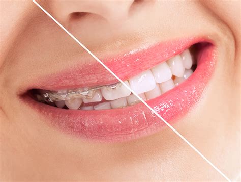 Profile OrthodonticsThe Ultimate SureSmile Braces Before and After | Profile Orthodontics