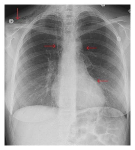 There is an evidence of pneumopericardium without evidence of right... | Download Scientific Diagram