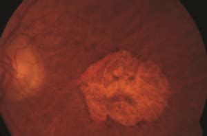 Geographic Atrophy | Macular Degeneration Association