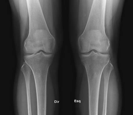 Normal Knee Joint