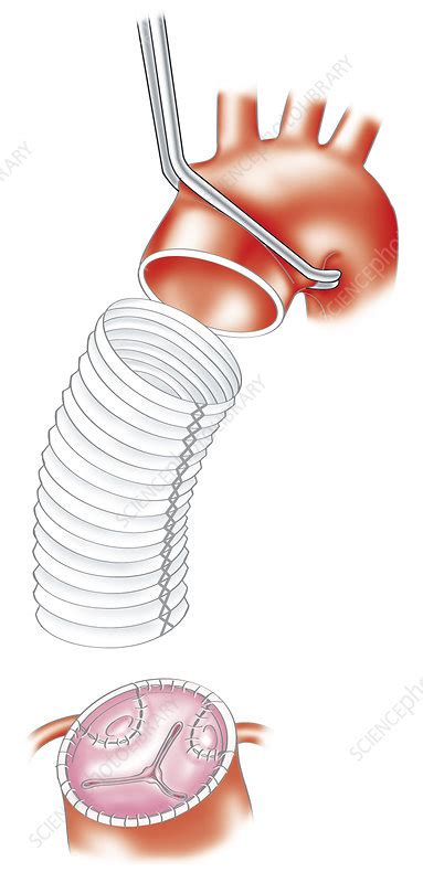 Bioprosthetic heart valve and aorta - Stock Image - C019/1500 - Science ...