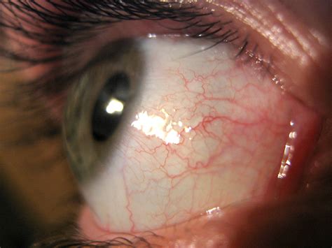 New Glaucoma Treatment May Restore Vision In Those With Optic Nerve Damage