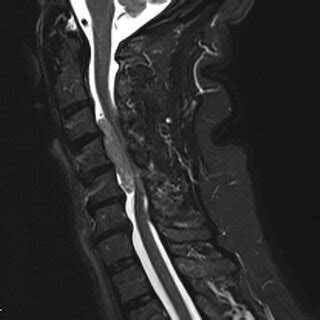 Sagittal T2-weighed MRI revealing an intradural extramedullary mass... | Download Scientific Diagram