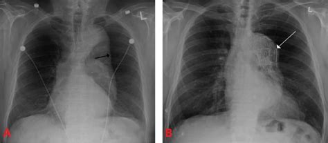 Thoracic Aortic Aneurysms - Clinical Features - Management - TeachMeSurgery