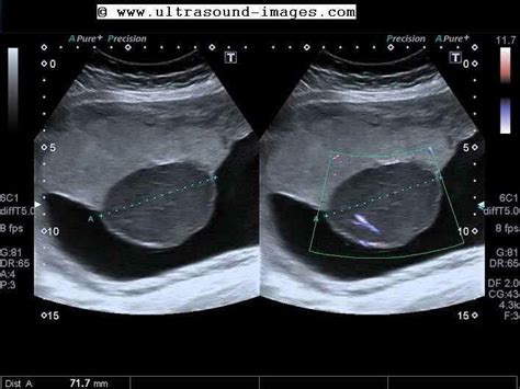 Placental mass. | Medical ultrasound, Obstetric ultrasound, Diagnostic medical sonography