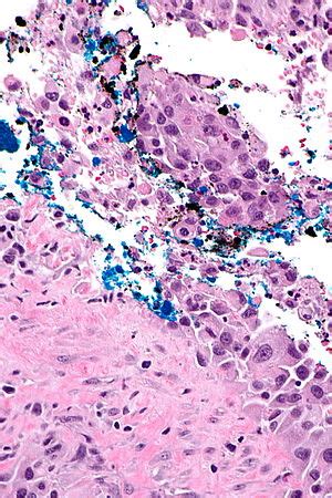 Urothelial carcinoma - Libre Pathology