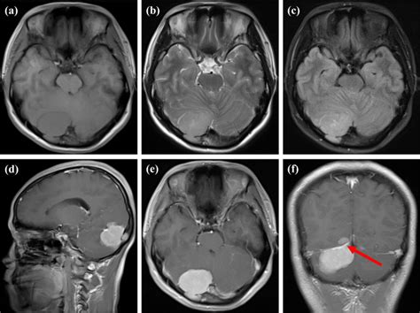 -MRI showed that there was a solid mass in the right occipital ...