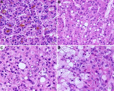 Benign Tumor Histology