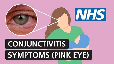 Signs And Symptoms Of Pink Eye (Conjunctivitis), 41% OFF