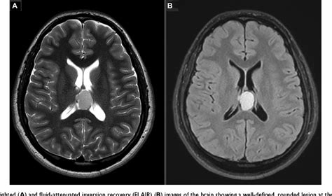 Figure 2 from A unique finding of cavum velum interpositum colloid-like cyst and literature ...