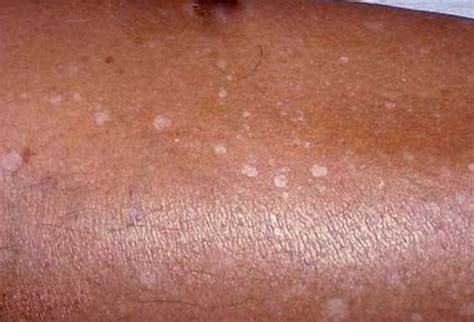 Dr. Modi's Homoeopathic Clinic: Vitiligo(Leucoderma) and Homoeopathy