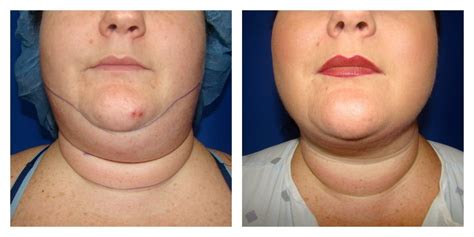 Chin Liposuction / Houston Lipo Center