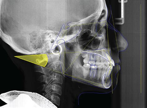 Cephalometric analysis. Measurement of the angle between the plane... | Download Scientific Diagram