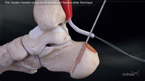 Arthrex - FHL Tendon Transfer