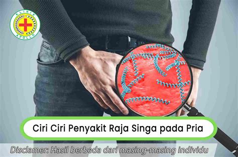 Kenali Tanda Gejala dan Ciri Ciri Penyakit Raja Singa pada Pria | Klinik Apollo Jakarta