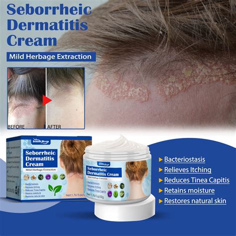 Buy seborrheic dermatitis cream, psoriasis scalp treatment ...