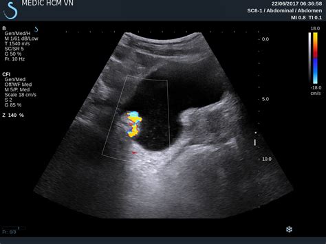 VIETNAMESE MEDIC ULTRASOUND: CASE 439: URINARY BLADDER TUMOR, Dr PHAN THANH HẢI, MEDIC MEDICAL ...