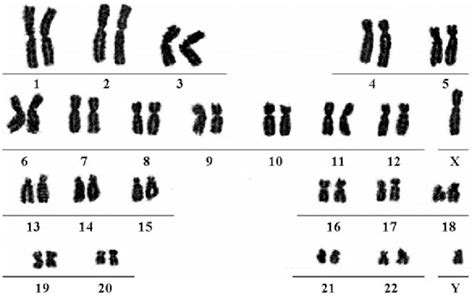 Karyotype analysis of B-HNF-1 cell culture: normal male karyotype 46, XY. | Download Scientific ...