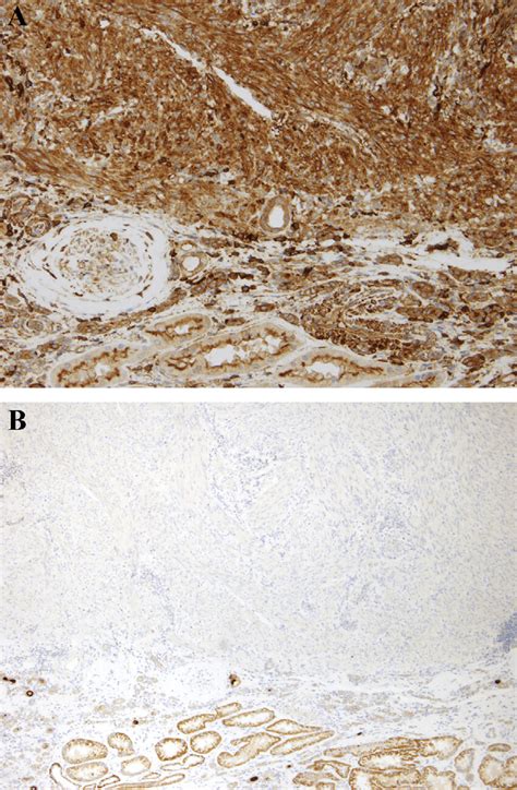 (A) Angiomyolipoma. The macroscopic myoid cell predominant ...