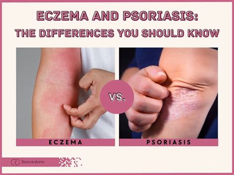 Psoriasis vs. Eczema: How to Tell Them Apart - Remotederm