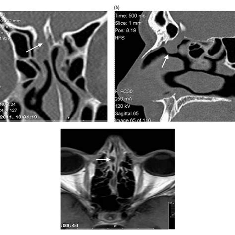 (a) CT Sinus scan: anomalous 'flask-shaped' anterior ethmoid air cell... | Download Scientific ...