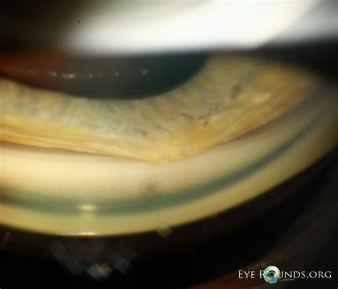 High peripheral anterior synechia in iridocorneal endothelial syndrome : The University of Iowa ...