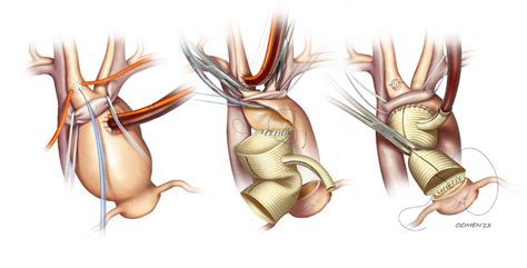 Aortic aneurysm repair :: Behance