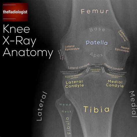 Read on for a system I use when looking at an AP knee X-Ray…⁣ ⁣ THE AP ...