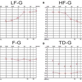 The examples of audiograms in four types of UISSNHL. (A) Shows an... | Download Scientific Diagram