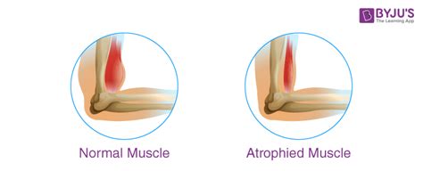 Types of Muscular Dystrophy- Causes, Symptoms, Treatment