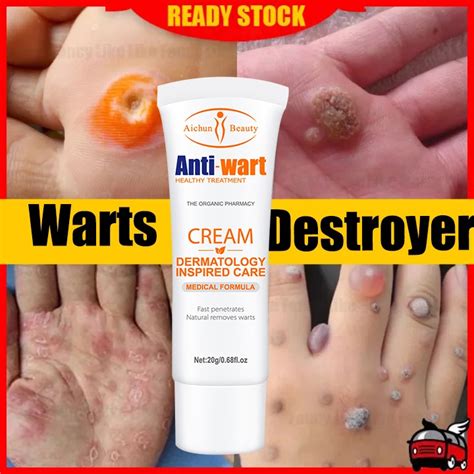 Wart Remover Warts Removal Ointment Cream Skin Tag Remover Ubat Buang ...