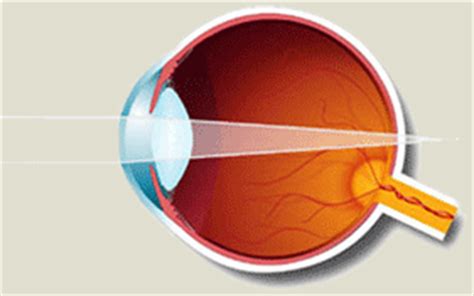 Hyperopia (Farsightedness) | Andrew Leung and Associates