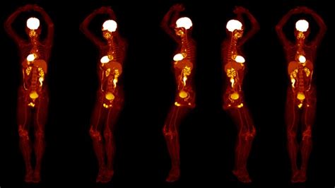 Whole-body PET scanner produces 3D images in seconds