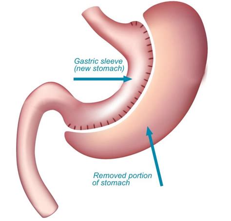 Nairobi Bariatric Center | Gastric Sleeve Kenya