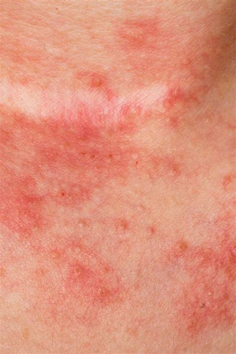 6 types of eczema: Symptoms and causes