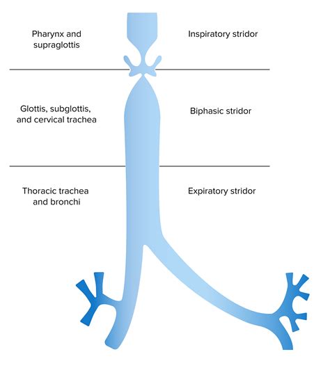 Laryngomalacia and Tracheomalacia | Concise Medical Knowledge