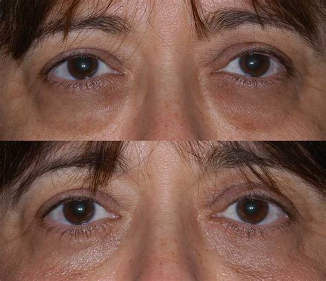 Lower Eyelid Surgery | Center for Excellence in Eye Care