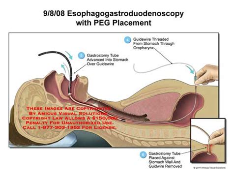 AMICUS Illustration of amicus,surgery,esophagogastroduodenoscopy,PEG ...