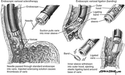 Esophageal varices: Acute management of portal hypertension | Abdominal Key