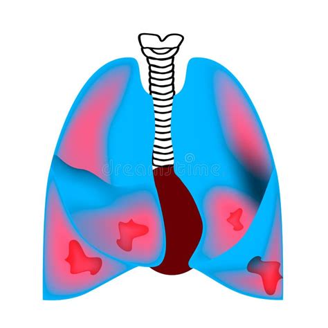 Bronchitis. The Anatomical Structure Of The Human Lung. Vector Illustration On A Gray Background ...