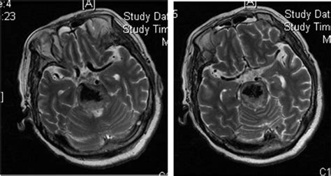 T 2 -weighted MRI (C, D) at 42 h after onset, showed primary pontine... | Download Scientific ...