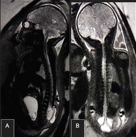 Sagittal (A and B) fetal MRI images show a dilated subarachnoid space... | Download Scientific ...