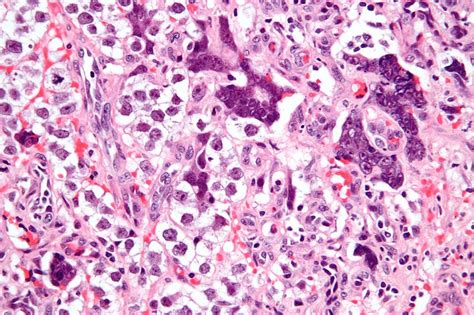 Seminoma pathophysiology - wikidoc