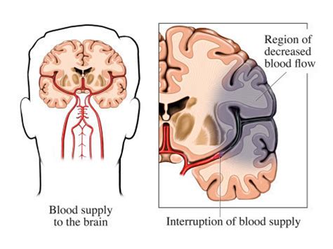 Cerebrovascular Disease