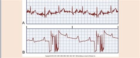 EKG Strips 🩺 Flashcards | Quizlet