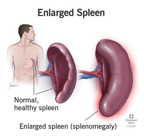 Normal And Enlarged Spleen