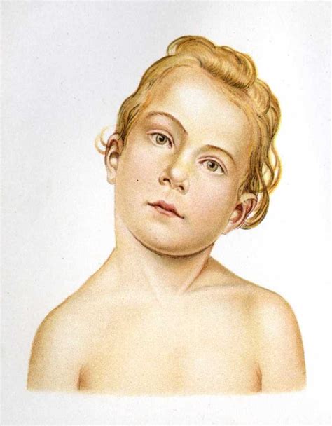 [Figure, A child with Torticollis Contributed by Wikimedia Commons (Public Domain)] - StatPearls ...