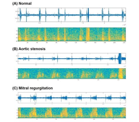 Representative phonocardiograms and spectrograms. (A) Normal heart ...